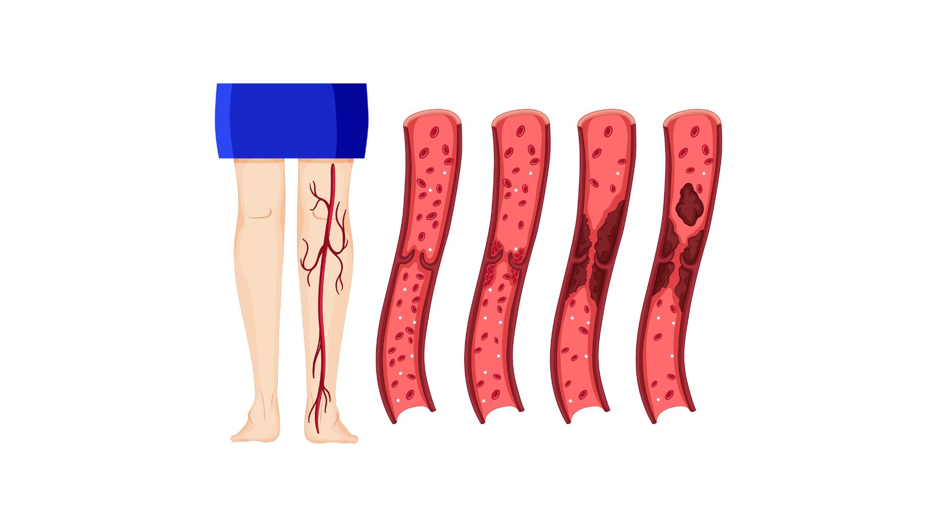 Yoga_para_las_varices